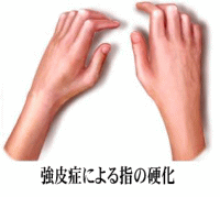 強皮症による指の硬化